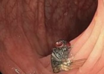 Penemuan Mengerikan Dunia Medis, Seekor Lalat Ditemukan Hidup di Usus Manusia