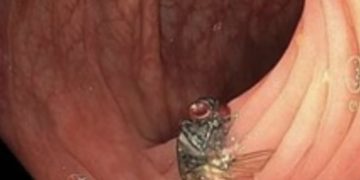 Penemuan Mengerikan Dunia Medis, Seekor Lalat Ditemukan Hidup di Usus Manusia