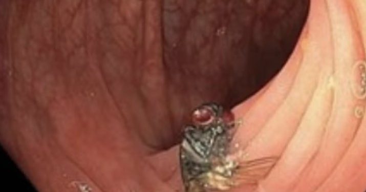 Penemuan Mengerikan Dunia Medis, Seekor Lalat Ditemukan Hidup di Usus Manusia